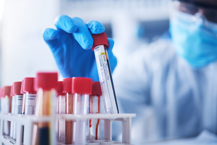 Lab technician selects a blood vial